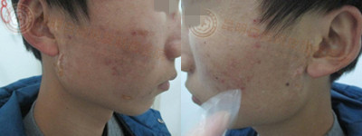 21岁男性面部白斑