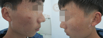 21岁男性面部白斑