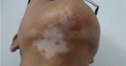 颈部白癜风为什么会久治不愈