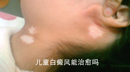 С¶ù°×ñ°·ç»¼ÕߵϤÀí