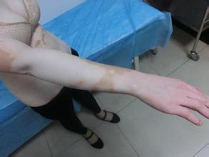 关节白癜风怎么护理