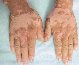 泛发型白癜风能治好吗